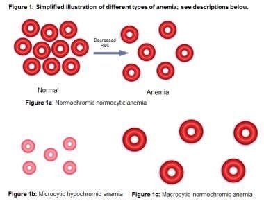 mean corpuscular hemoglobin concentration low platelets high.